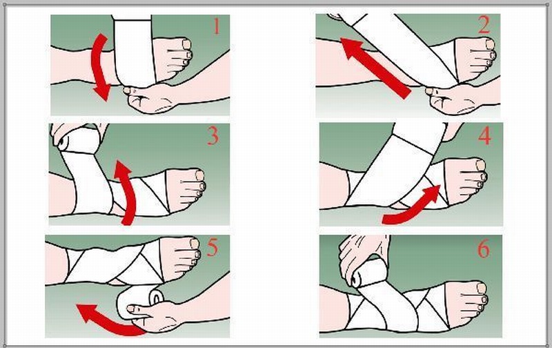 Các bước cụ thể khi đóng gói băng Cách quấn băng khi bị lật cổ chân: 3 bước hướng dẫn chi tiết